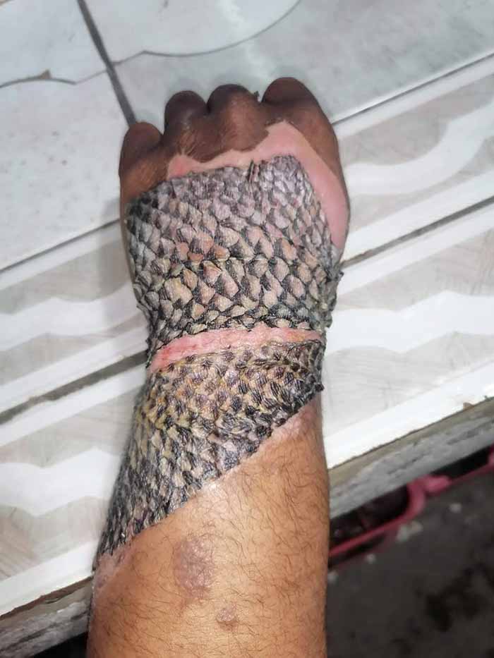 El innovador tratamiento con piel de tilapia está cambiando la forma de sanar quemaduras en Brasil (Crédito: X)
