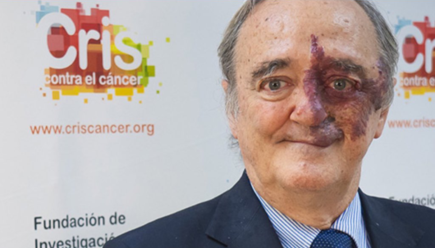 La terapia logró frenar y eliminar el cáncer en ratones.